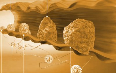 Tumori Stromali Gastrointestinali (GIST): cause, sintomi e trattamenti