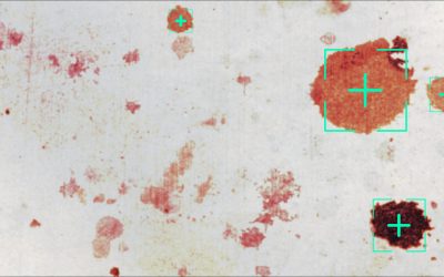 Sarcoma di Kaposi: cure e trattamenti